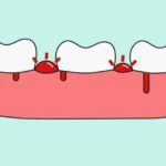 Dantenų ligų prevencija: Tinkamas dantų valymas